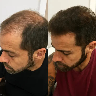 Reduced Hair Loss & New Growth